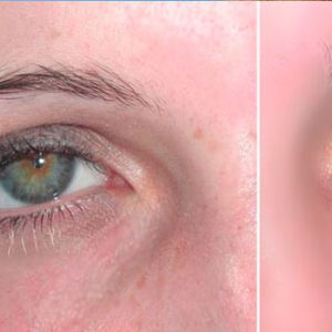 Arreglar imperfecciones con Photoshop